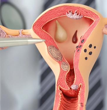 Types and symptoms and treatment of Gynecologic Cancers